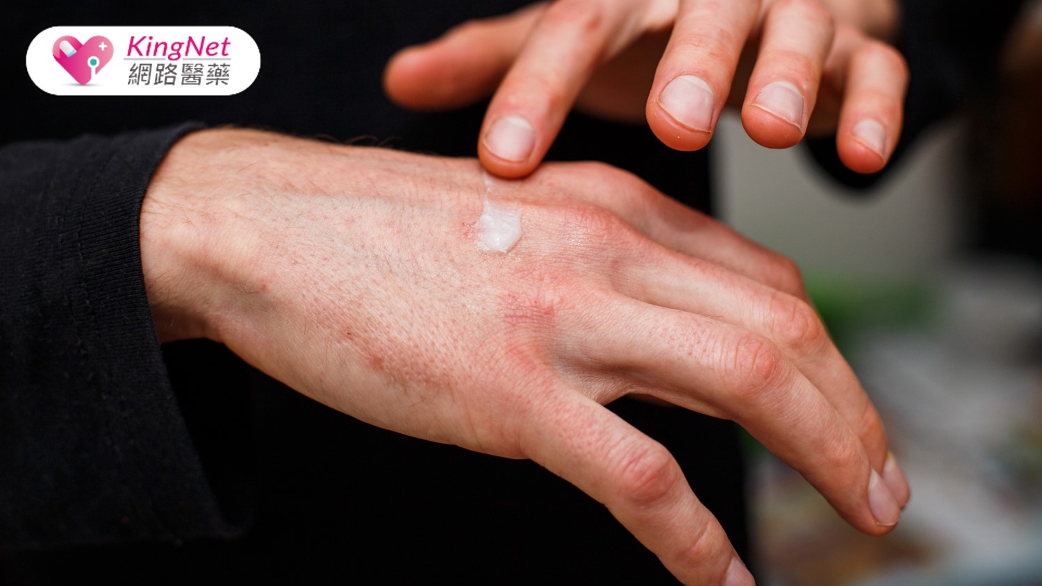 高三生長期飽受異位性皮膚炎困擾，醫師分享抗癢治療與皮膚保養三大關鍵_圖1