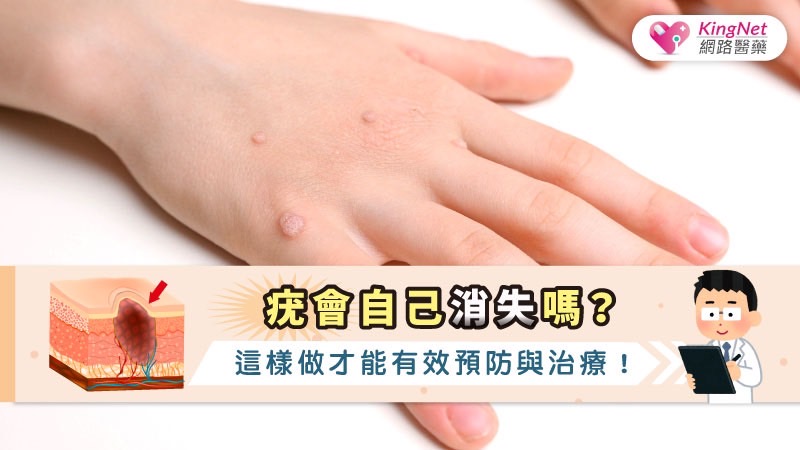 疣會自己消失嗎？這樣做才能有效預防與治療！_圖1