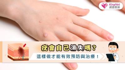 疣會自己消失嗎？這樣做才能有效預防與治療！