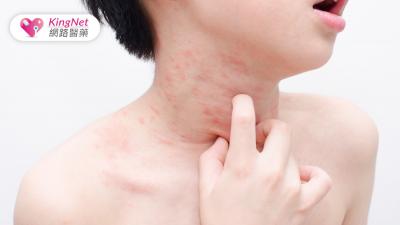 異位性皮膚炎恐影響身心發展，生物製劑精準治療助重拾健康！