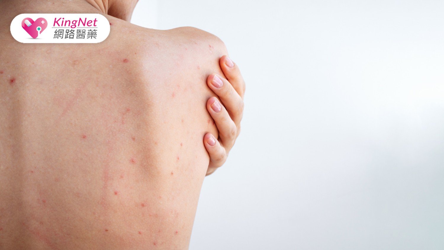 流汗、壓力、穿衣習慣都中招？身體長痘元兇竟是這些日常行為_圖1