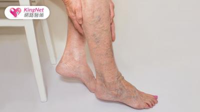 靜脈曲張別拖！微創膠水療法讓你輕鬆擺脫疼痛