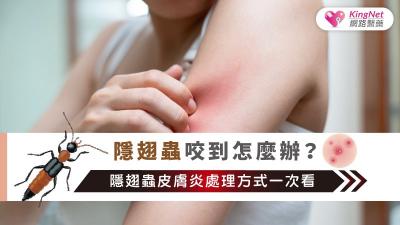 隱翅蟲咬到怎麼辦？隱翅蟲皮膚炎處理方式一次看！