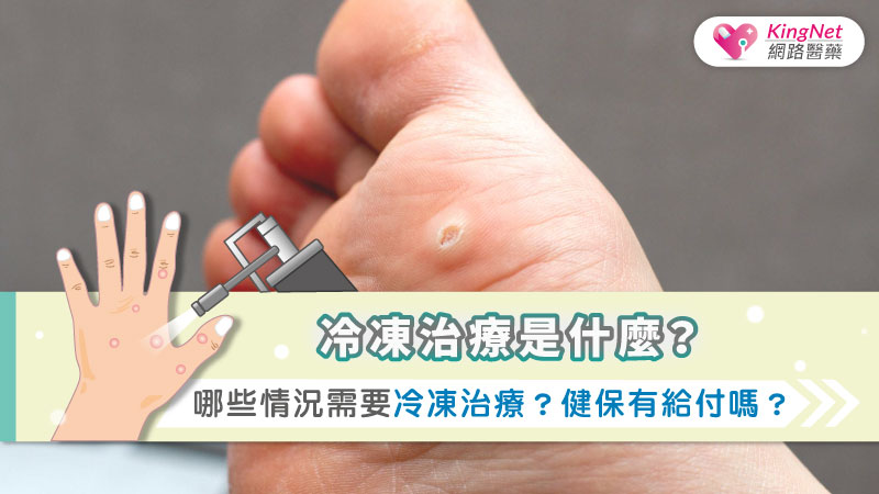 冷凍治療是什麼？哪些情況需要冷凍治療？健保有給付嗎？_圖1