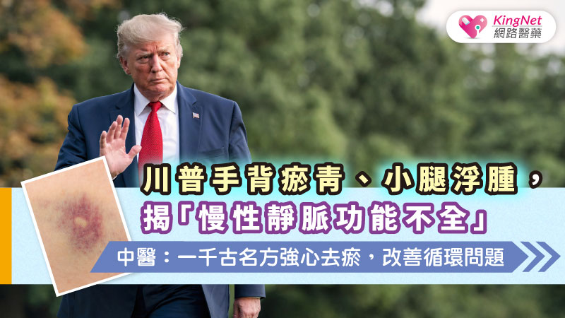 川普手背瘀青、小腿浮腫，揭「慢性靜脈功能不全」 中醫： 一千古名方強心去瘀，改善循環問題_圖1