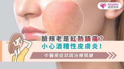 臉頰老是紅熱脹痛？小心酒糟性皮膚炎！中醫揭症狀與治療關鍵
