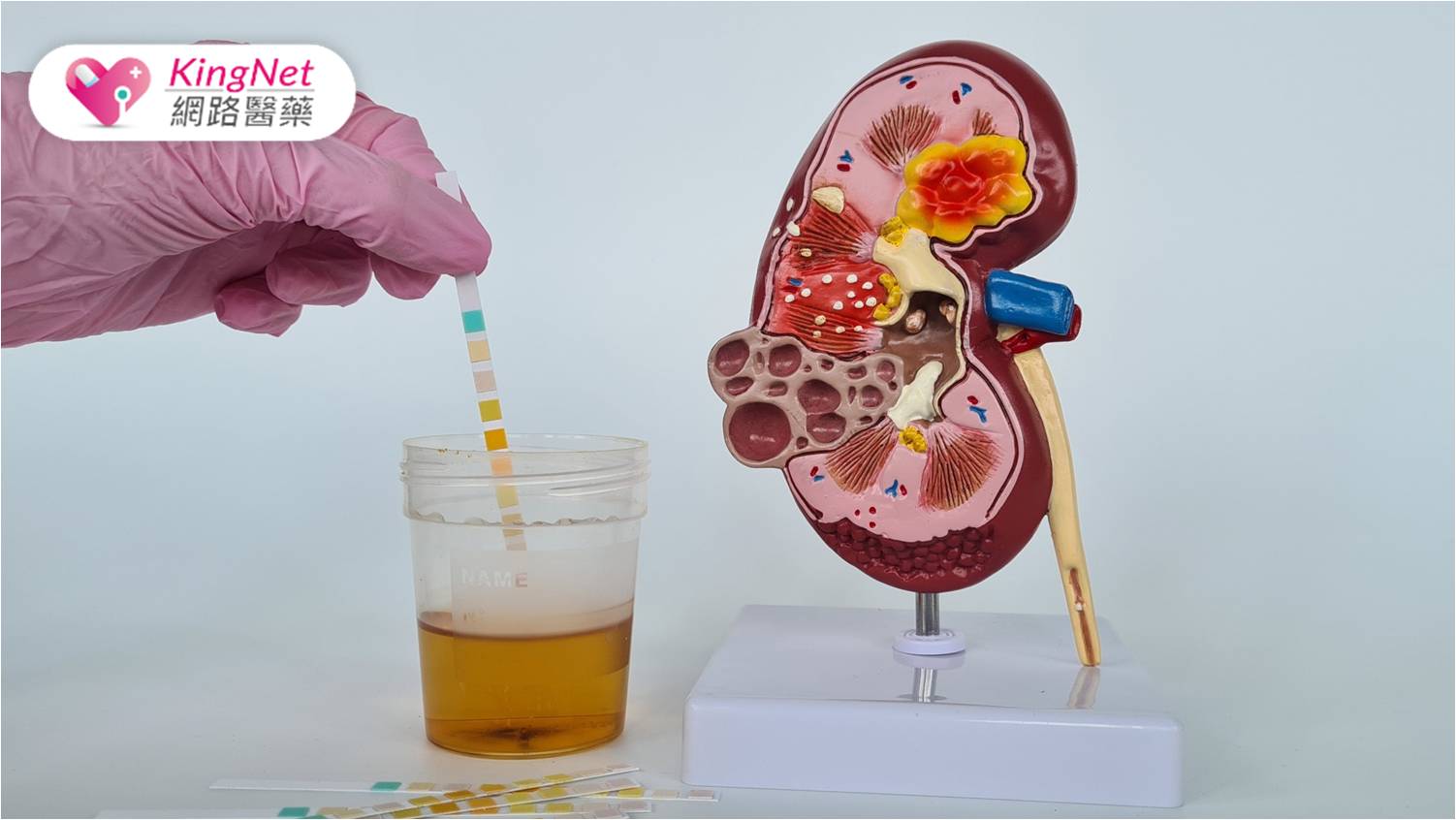 近300萬筆數據揭密糖尿病腎病風險！　竟然早在「糖尿病前期」就已曝險？_圖1