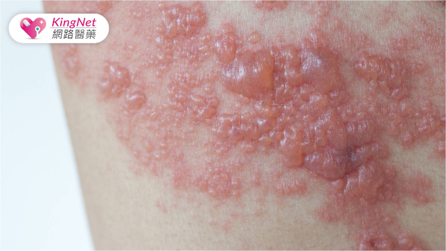 皮蛇痛不只因皮膚受損而是「神經」！　了解帶狀皰疹風險、警訊、易發族群