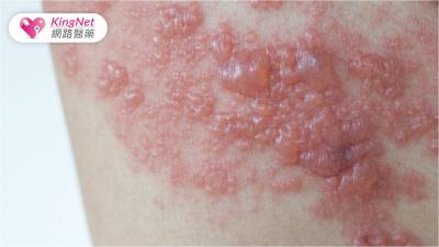 皮蛇痛不只因皮膚受損而是「神經」！　了解帶狀皰疹風險、警訊、易發族群