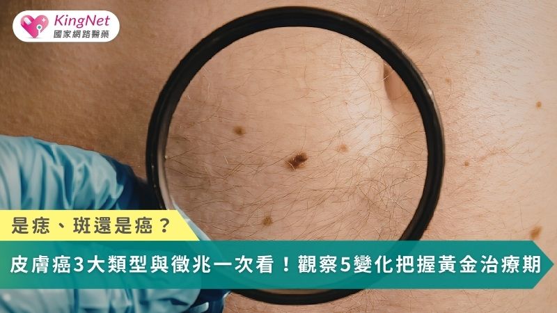 是痣、斑還是癌？　皮膚癌3大類型與徵兆一次看！觀察5變化把握黃金治療期_圖1