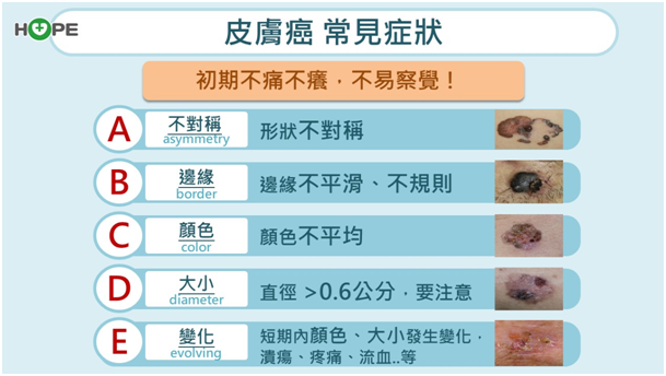 是痣、斑還是癌？　皮膚癌3大類型與徵兆一次看！觀察5變化把握黃金治療期_圖4
