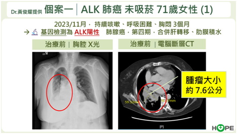 肺癌ALK標靶治療策略解析　最強的藥應先用？還是留到後面以免無藥可醫？_圖4