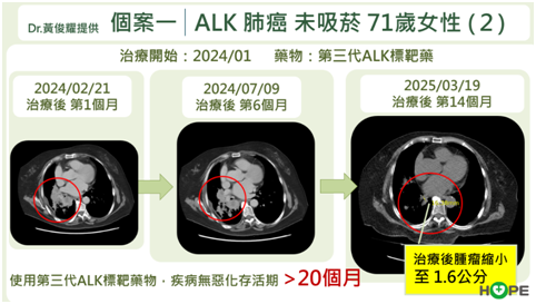 肺癌ALK標靶治療策略解析　最強的藥應先用？還是留到後面以免無藥可醫？_圖5