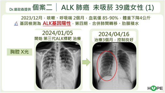 肺癌ALK標靶治療策略解析　最強的藥應先用？還是留到後面以免無藥可醫？_圖6