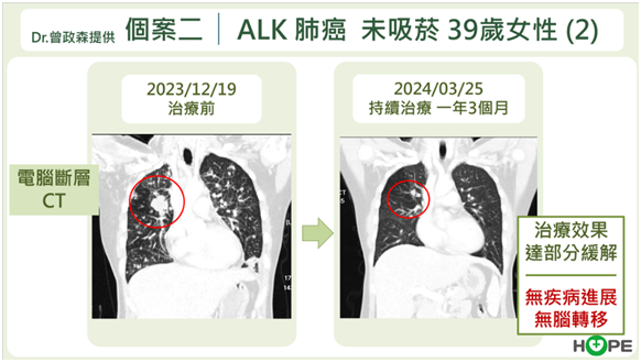 肺癌ALK標靶治療策略解析　最強的藥應先用？還是留到後面以免無藥可醫？_圖7