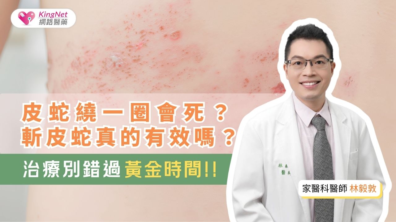 【影】帶狀皰疹年輕化　治療把握黃金時間！皮蛇繞一圈會死？斬皮蛇真的有效？_圖1