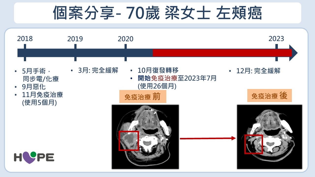假牙磨損竟會致「頭頸癌」？喉嚨不適超過2週是警訊　了解治療新趨勢！_圖7