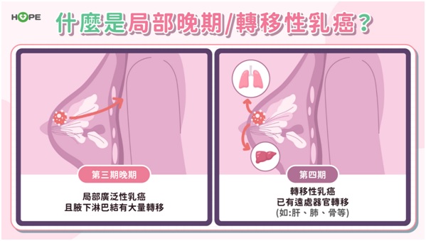 乳癌治療新曙光！認識新一代ADC藥物　有哪些治療優勢？有無健保給付？_圖2