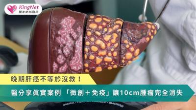 晚期肝癌不等於沒救！醫分享真實案例　「微創＋免疫」讓10cm腫瘤完全消失