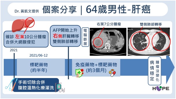 晚期肝癌不等於沒救！醫分享真實案例　「微創＋免疫」讓10cm腫瘤完全消失_圖2