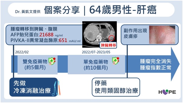 晚期肝癌不等於沒救！醫分享真實案例　「微創＋免疫」讓10cm腫瘤完全消失_圖3