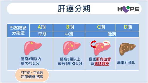 晚期肝癌不等於沒救！醫分享真實案例　「微創＋免疫」讓10cm腫瘤完全消失_圖8