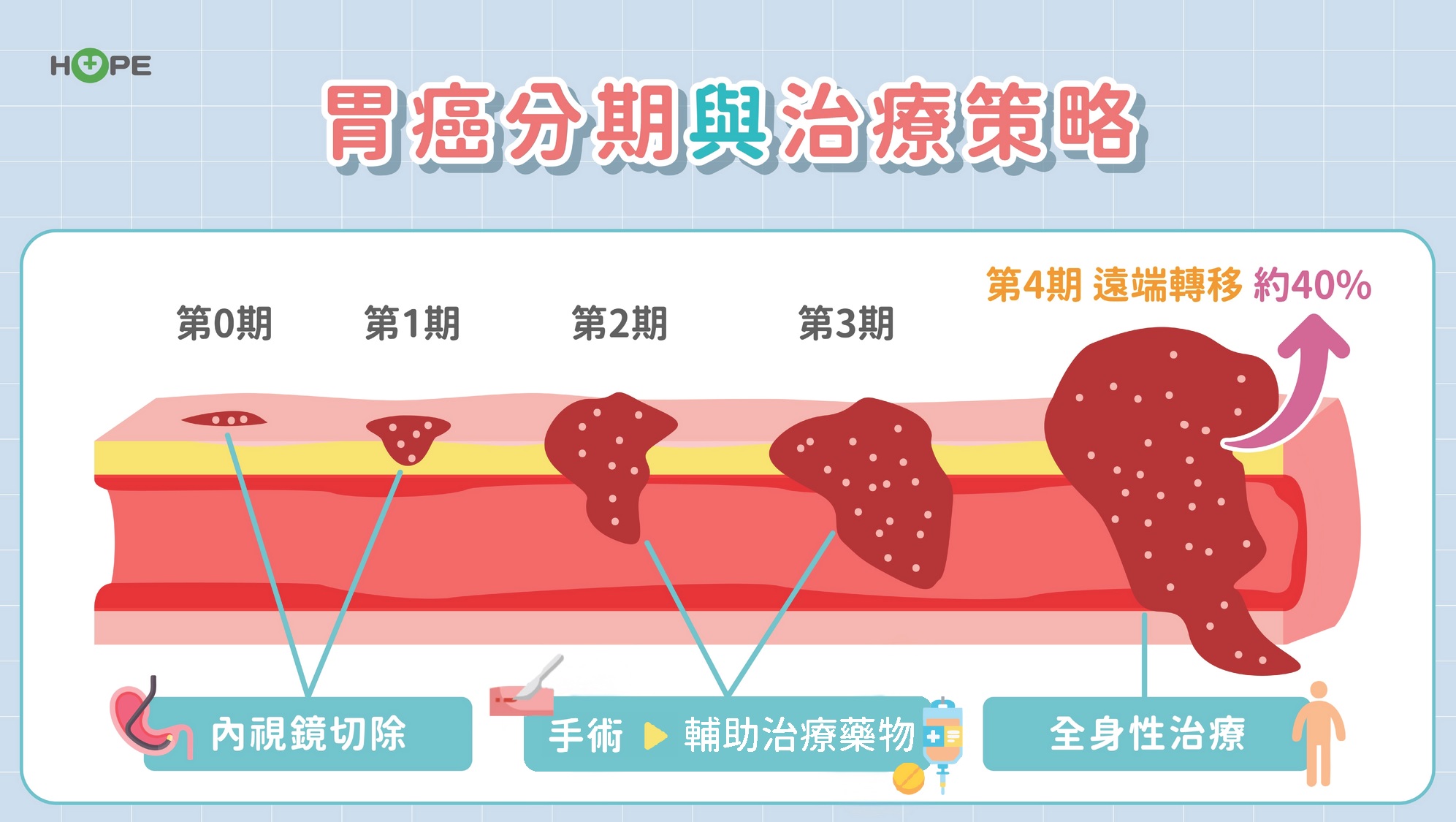 胃癌一定要全胃切除？最新治療趨勢「圍手術期治療」　助保胃、提升存活率！_圖2