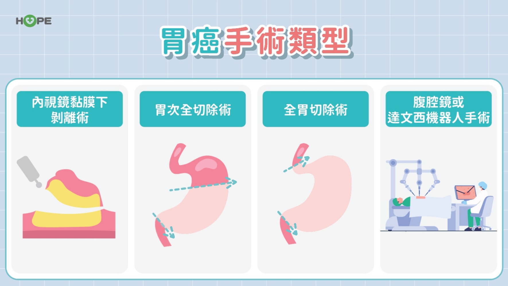 胃癌一定要全胃切除？最新治療趨勢「圍手術期治療」　助保胃、提升存活率！_圖4