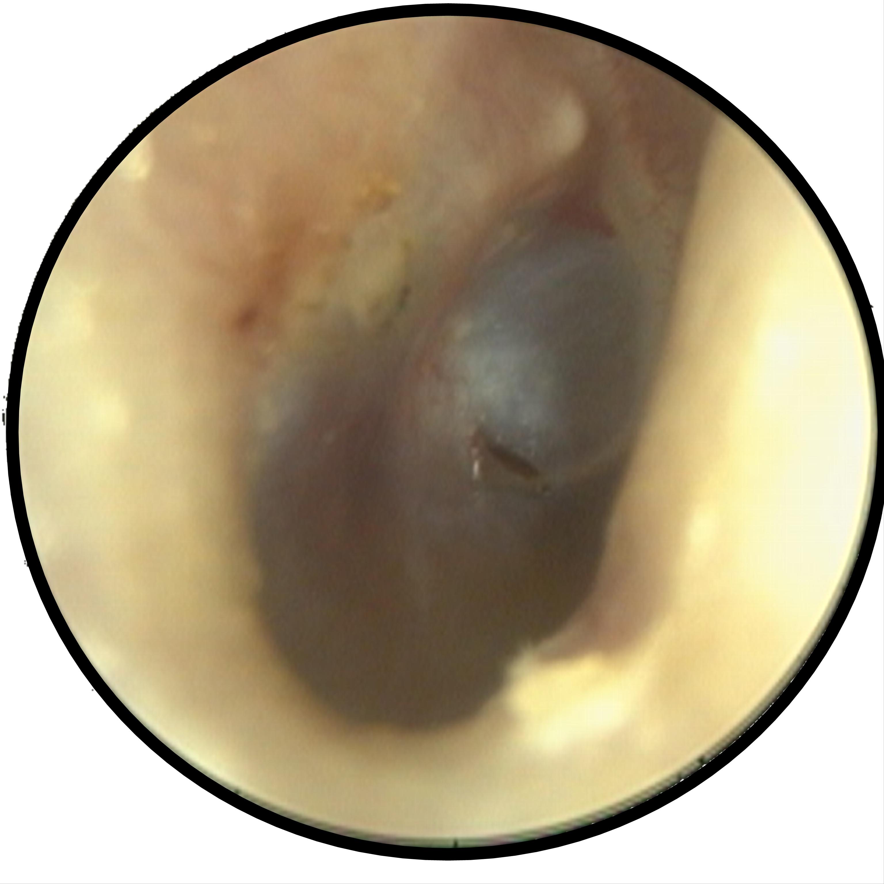 中耳炎怎麼辦？醫師談急性積液性中耳炎成因、症狀解析_圖2
