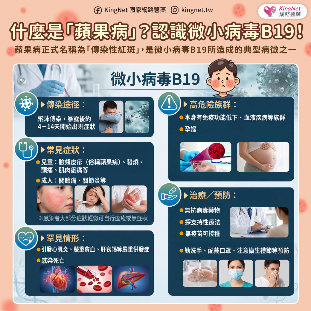 「你聽過「蘋果病」嗎？　了解微小病毒B19感染症狀、預防！」健康懶人包